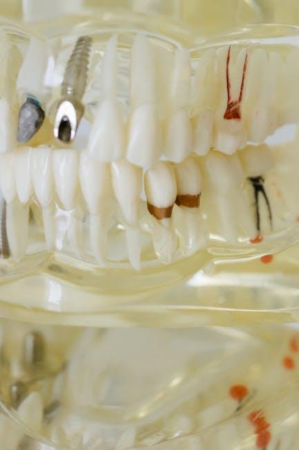 dental implants