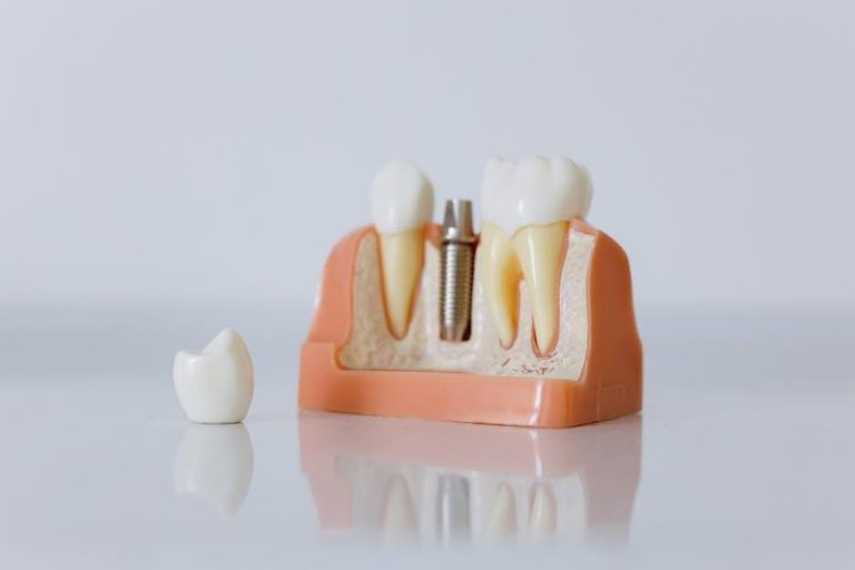 Implantology Driving Growth in Dental Market – Dentistry Today