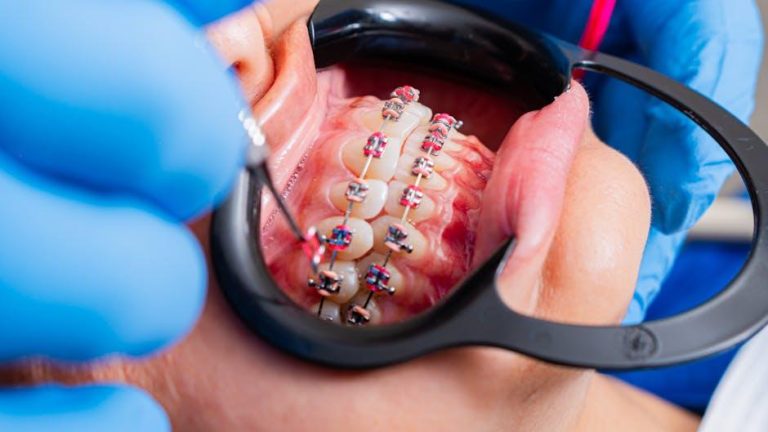 Making San Antonio Smile: free dental cleanings offered for kids aged 4-17 – WOAI