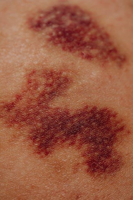 subcutaneous emphysema