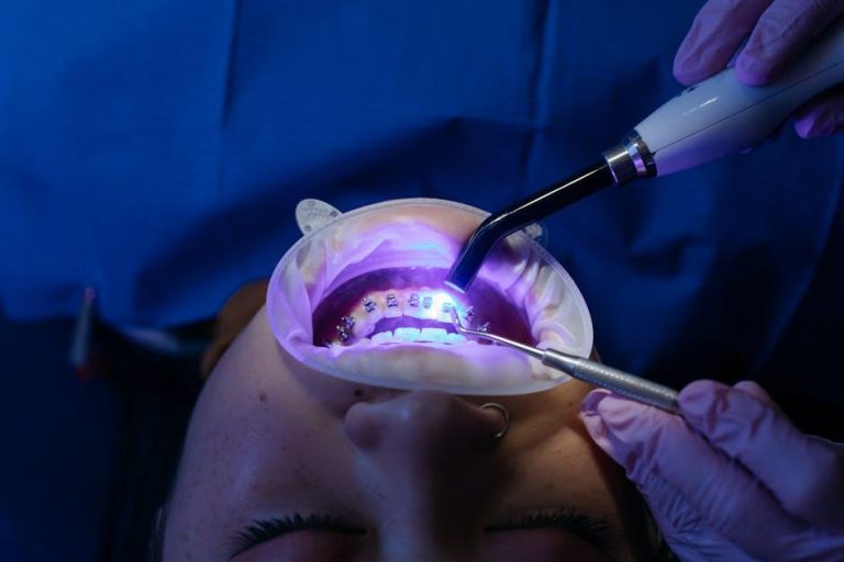 The Best Teeth Whitening Kits, According to Cosmetic Dentists – Vogue