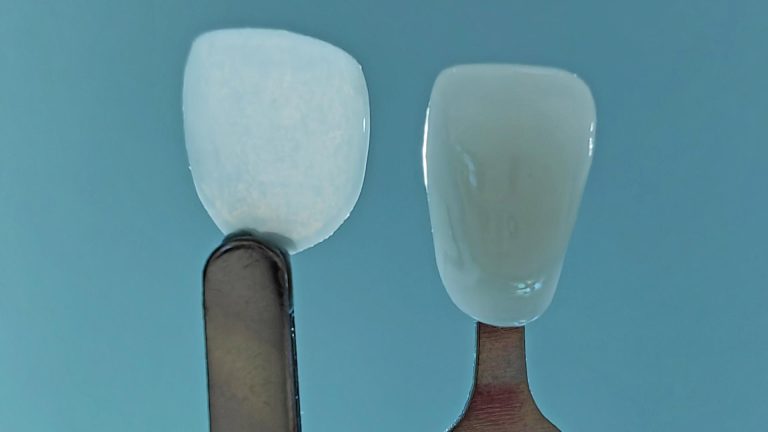 Launch of UltraThineer, world’s thinnest cosmetic dental veneer – Dental Tribune US