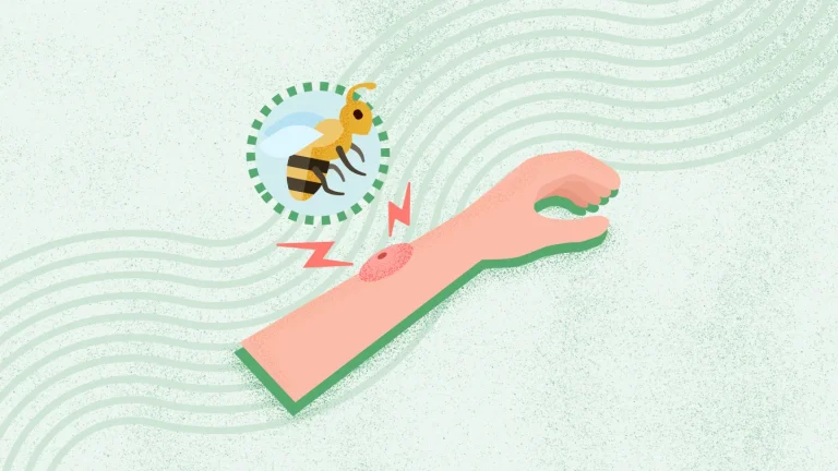 Bug Bites and Stings: Everything You Need to Know