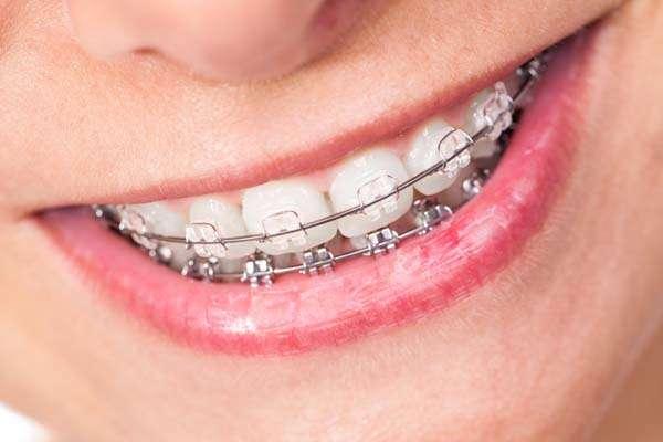 FASTBRACES