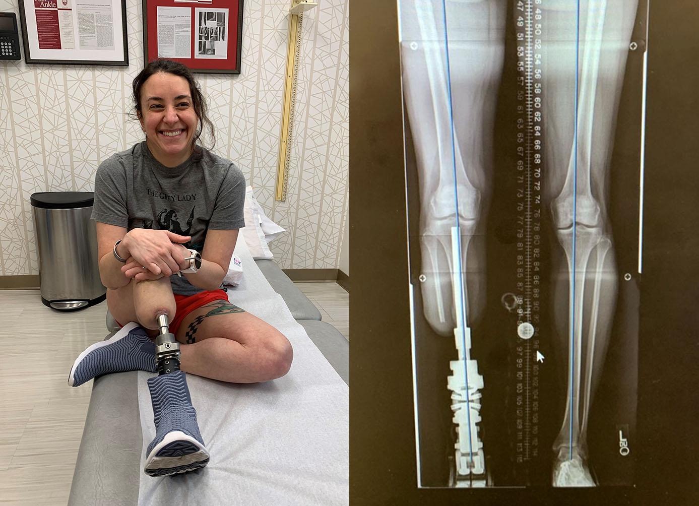 Osseointegration