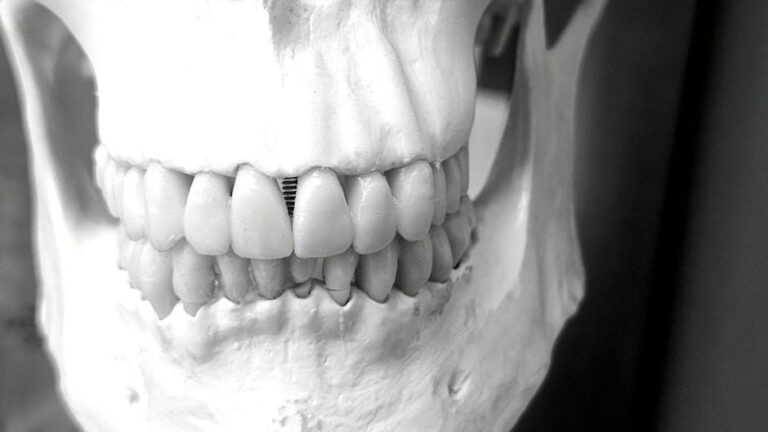 Dental Bone Graft Market Surging Globally – Dentistry Today