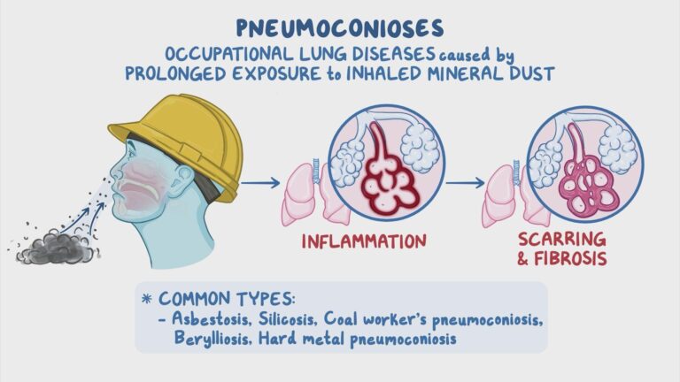 Early signs of pneumoconiosis in a dental technician in Italy: a case report – BMC Pulmonary Medicine