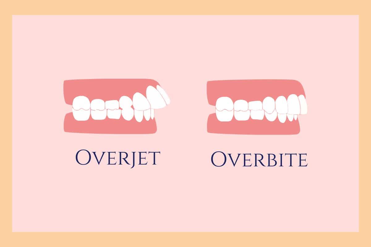Overjet